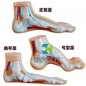 “康為醫(yī)療”正常足、扁平足、弓型足模型