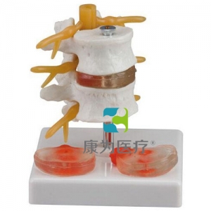 “康為醫(yī)療”2節(jié)腰椎附2個病變椎間盤模型